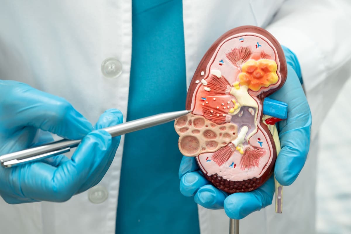 Personalized Care & Treatment Approach for Kidney Stones